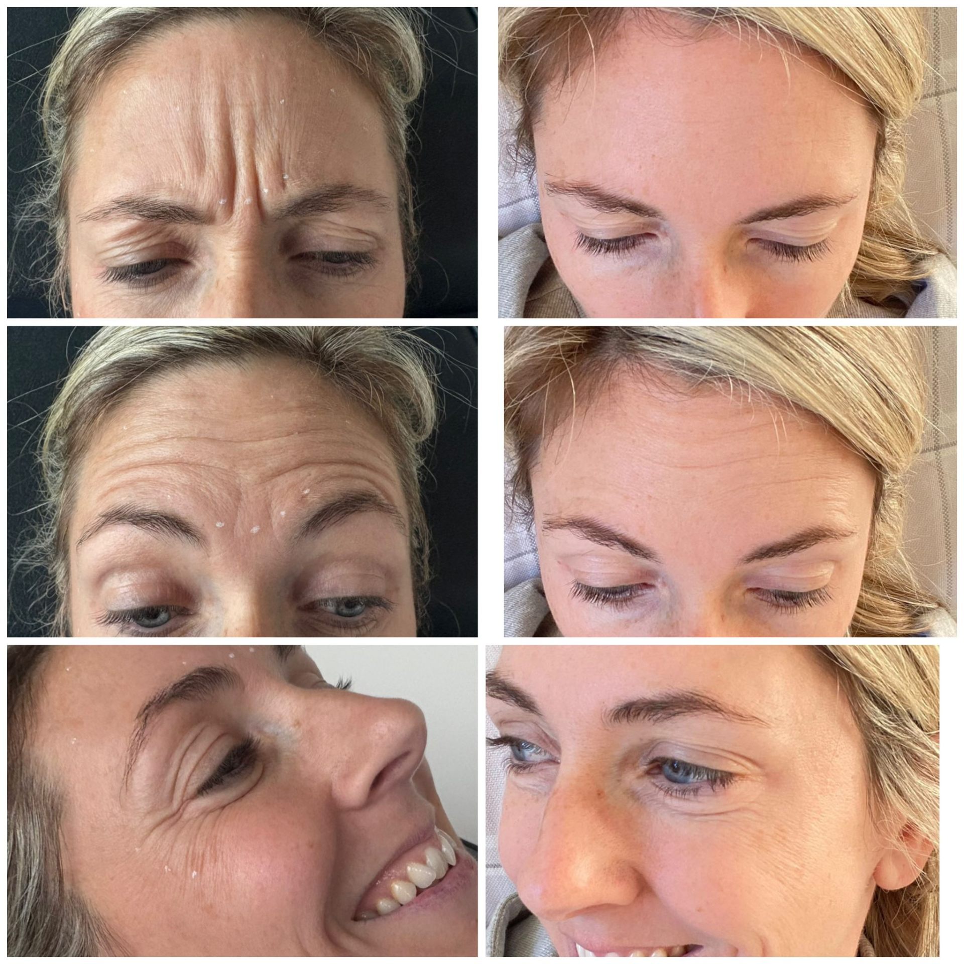 Anti-wrinkle treatment before and after — forehead and frown lines softened