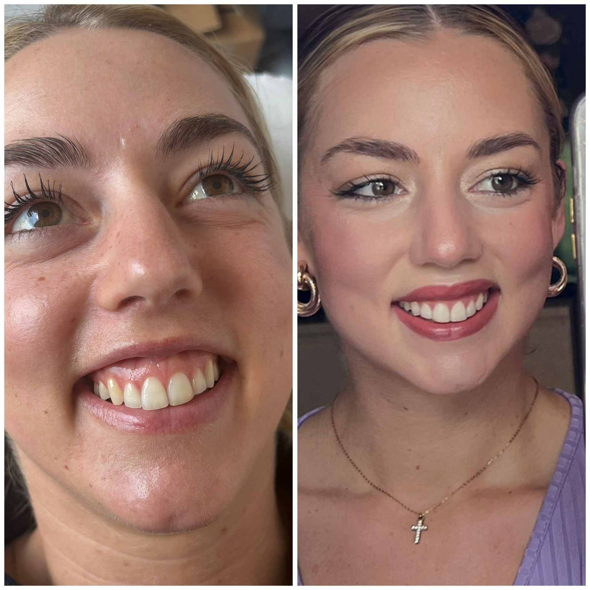 Lip flip and gummy smile treatment before and after